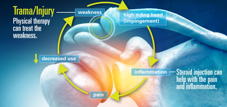Diagram of shoulder joint with cycle of pain occurrence and treatment options.